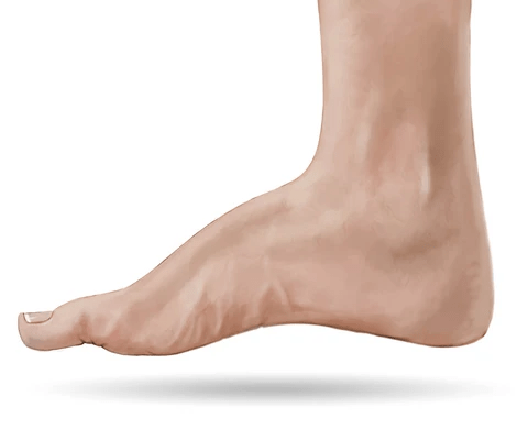 High Arch Foot Treatment