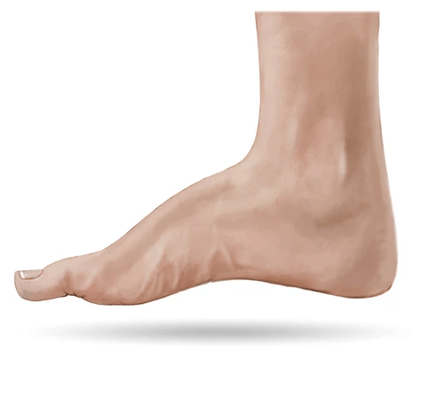 High Arch Foot Treatment