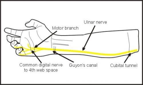 ULNAR NERVE PALSY TREATMENT