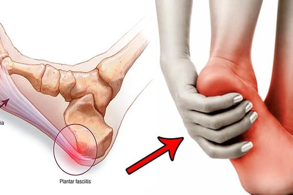What Is Planter Fasciitis?