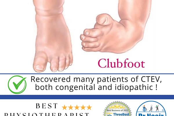 Club Foot Treatment in Dwarka